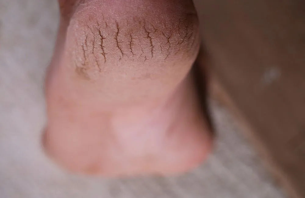 A close-up of a severely dry, cracked heel showing deep fissures, suggesting a need for intense moisture from a product like tallow balm