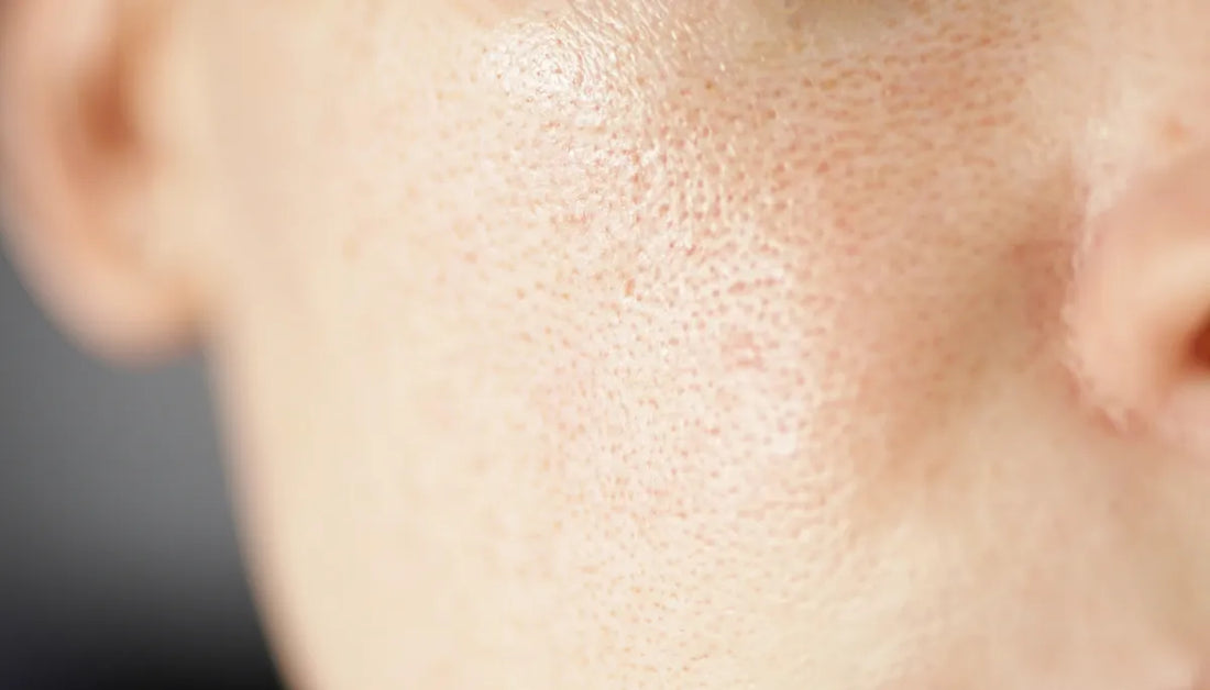 Close up visual of enlarged pores on a woman's face with oily skin.